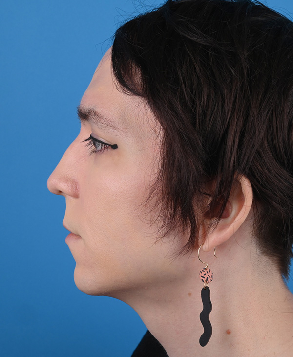 Rhinoplasty