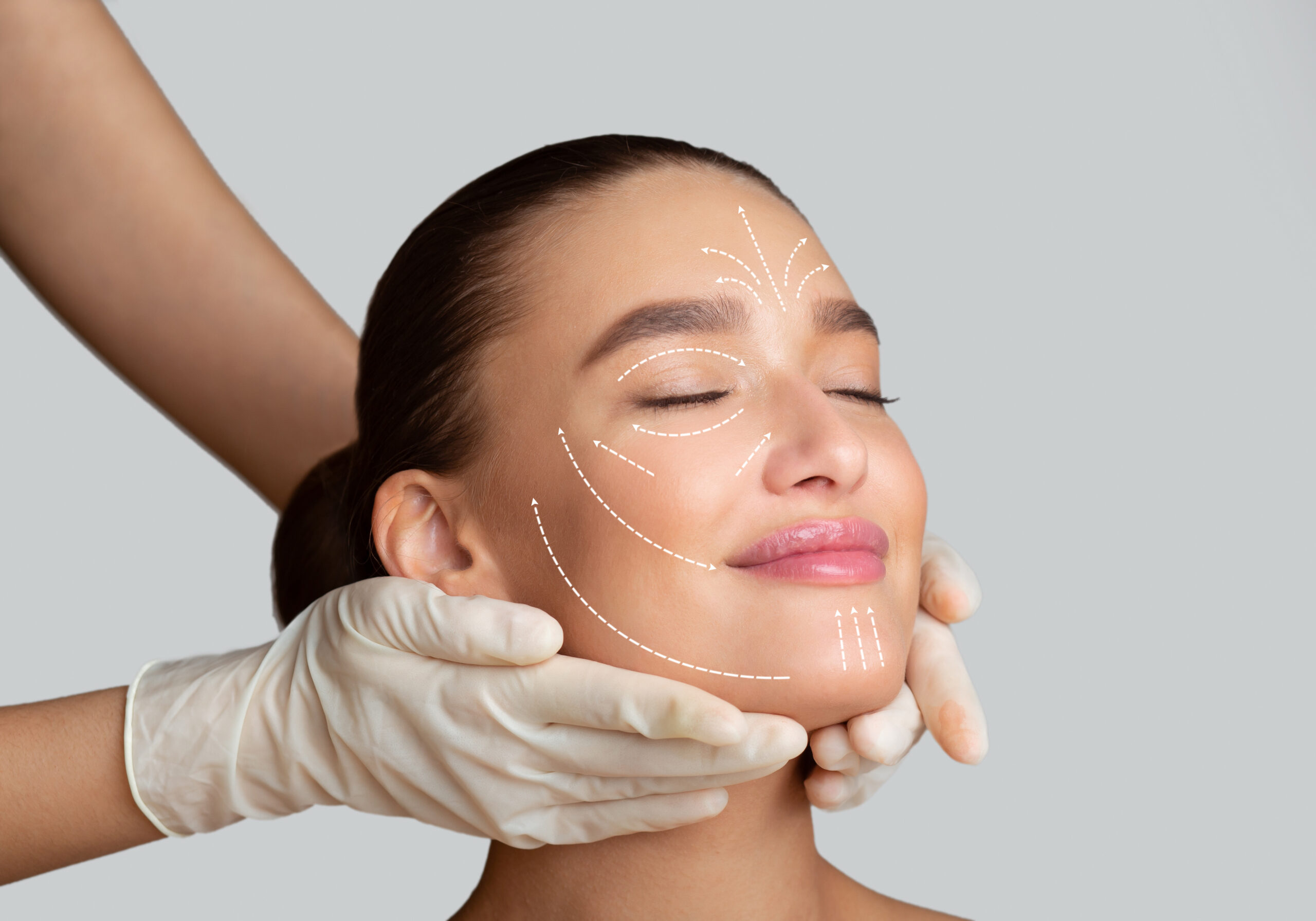 Woman’s face with facelift treatment markings