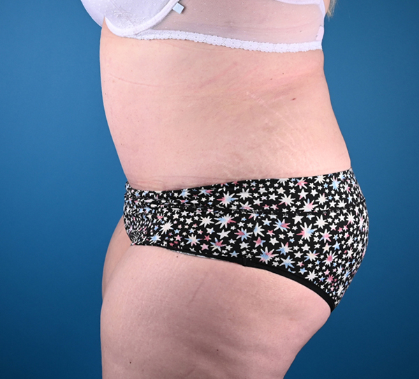 Abdominoplasty