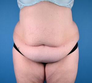 Abdominoplasty