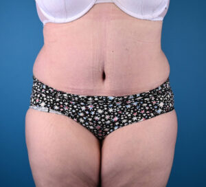 Abdominoplasty