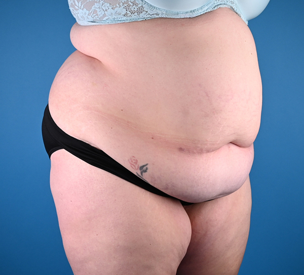 Abdominoplasty