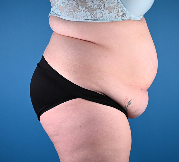 Abdominoplasty