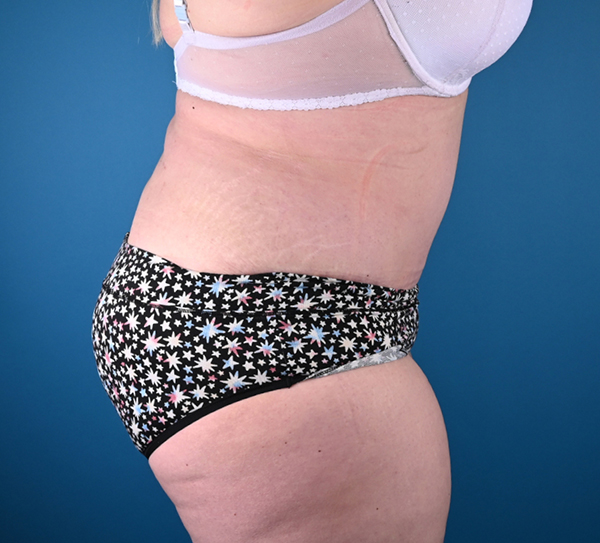 Abdominoplasty