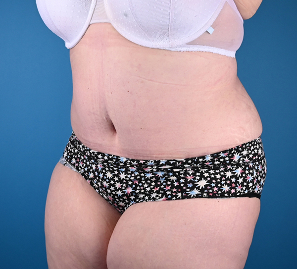 Abdominoplasty