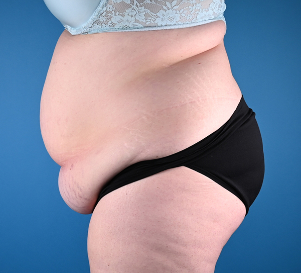 Abdominoplasty