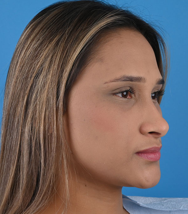 Rhinoplasty