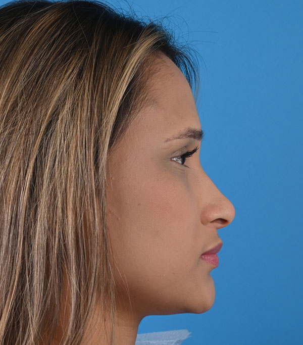 Rhinoplasty