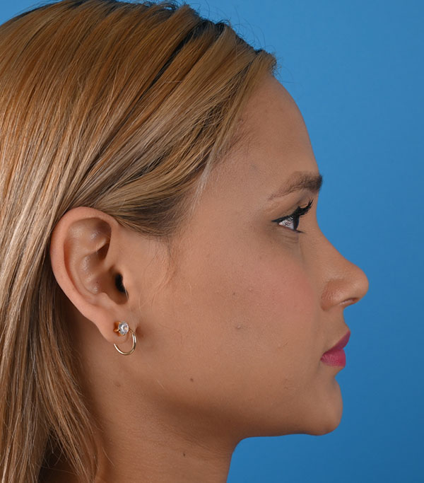 Rhinoplasty