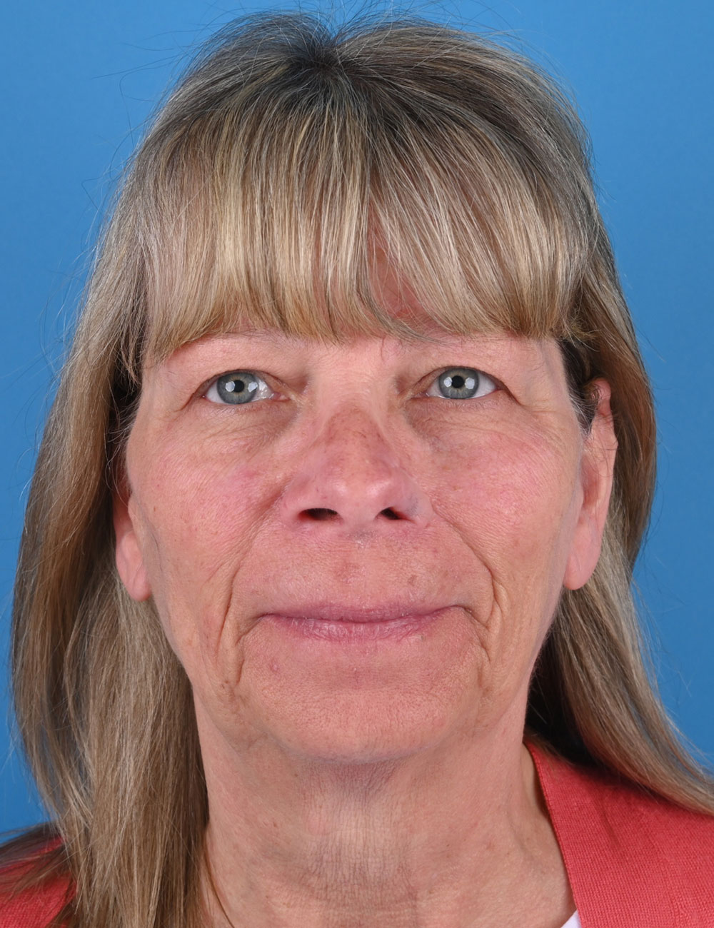 Nasal Reconstruction