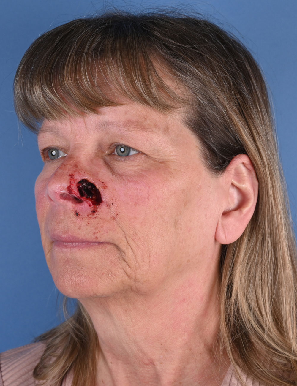Nasal Reconstruction