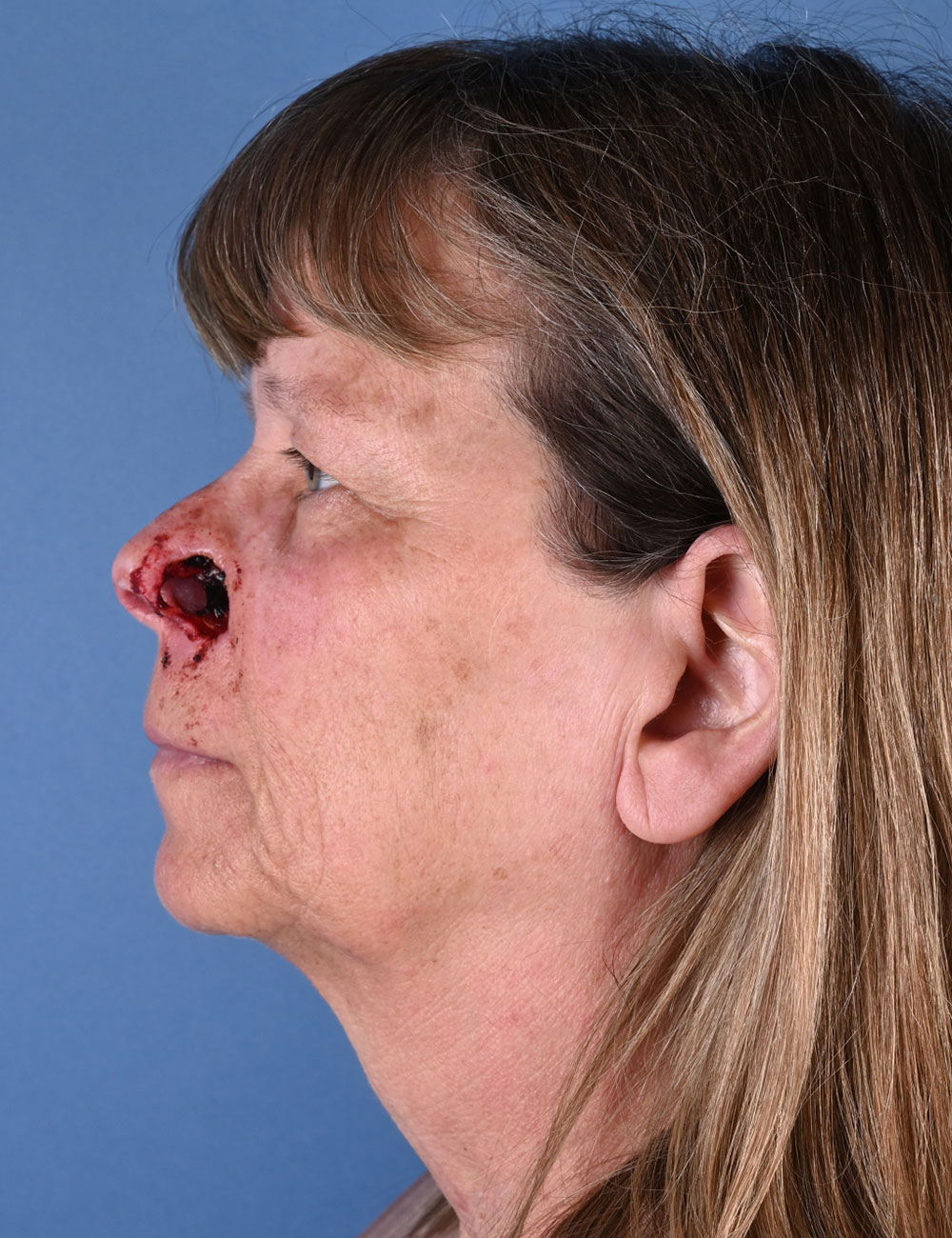 Nasal Reconstruction