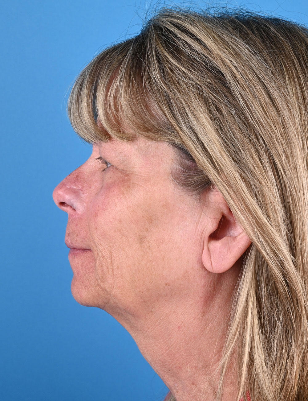 Nasal Reconstruction