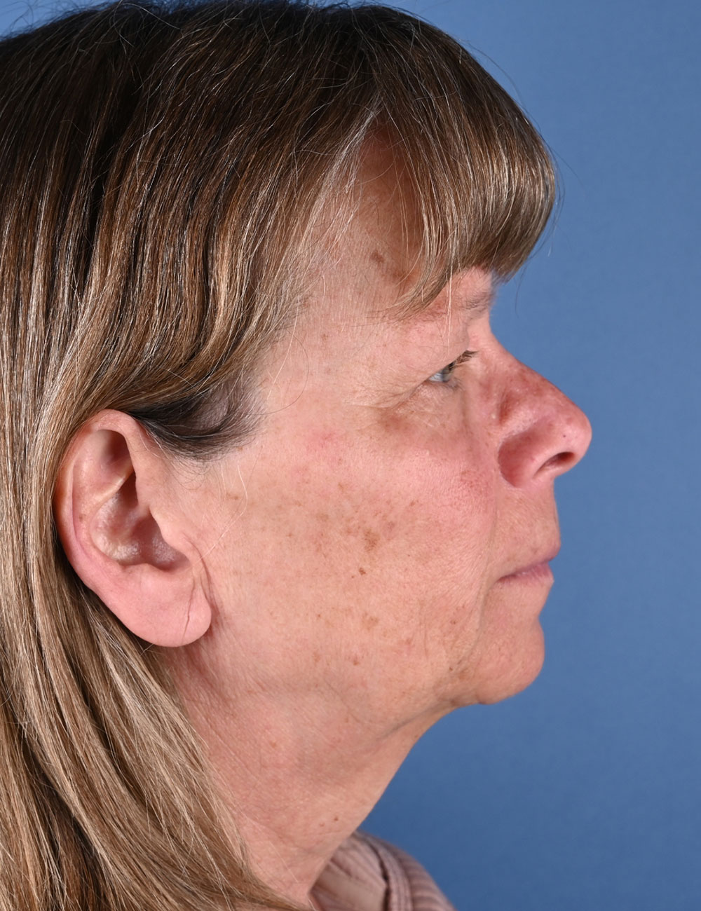 Nasal Reconstruction