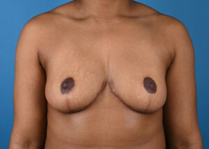 After breast augmentation Front View After breast augmentation Front View