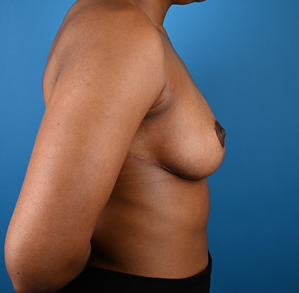 Breast Reduction