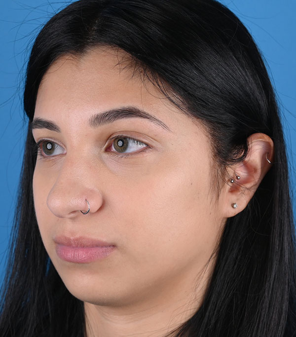 Rhinoplasty