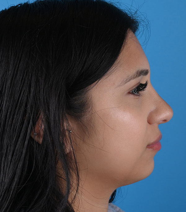 Rhinoplasty