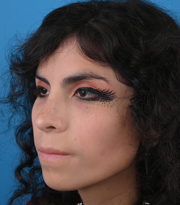 Rhinoplasty