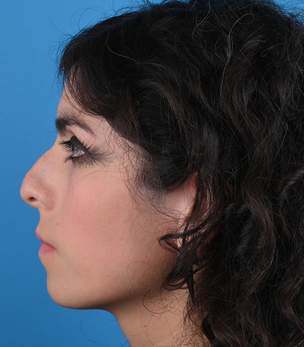 Rhinoplasty