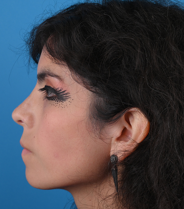 Rhinoplasty