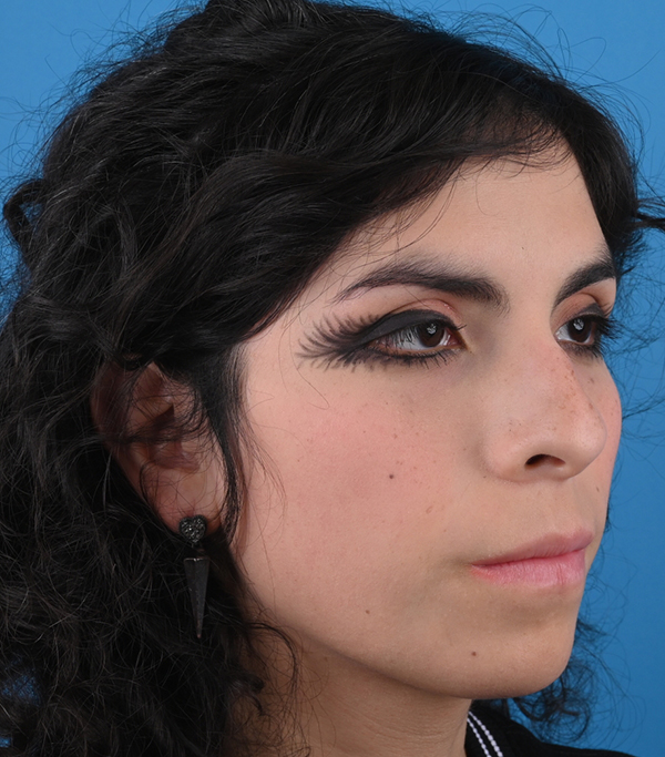 Rhinoplasty