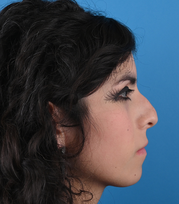 Rhinoplasty