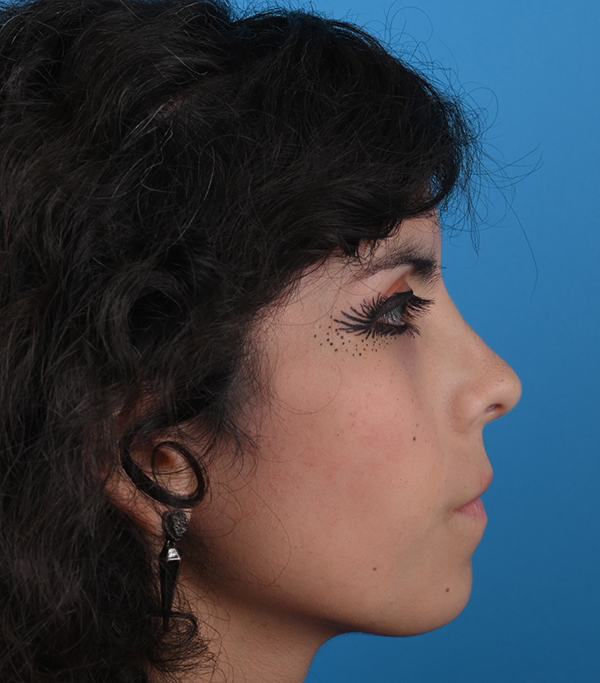 Rhinoplasty