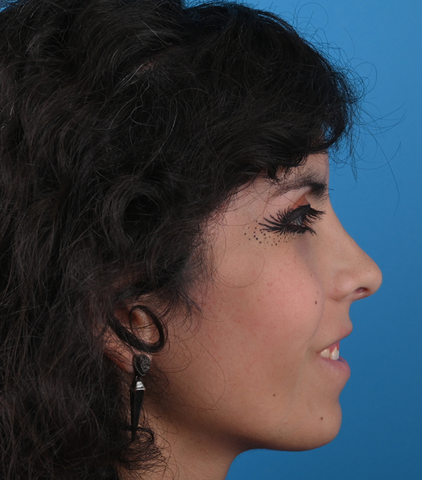 Rhinoplasty