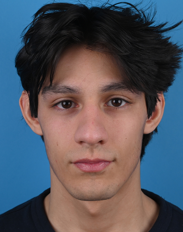 Otoplasty