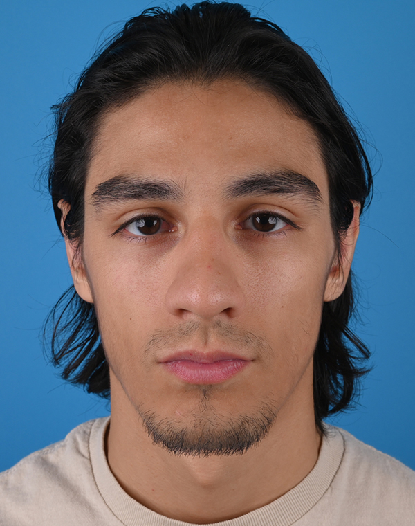Otoplasty