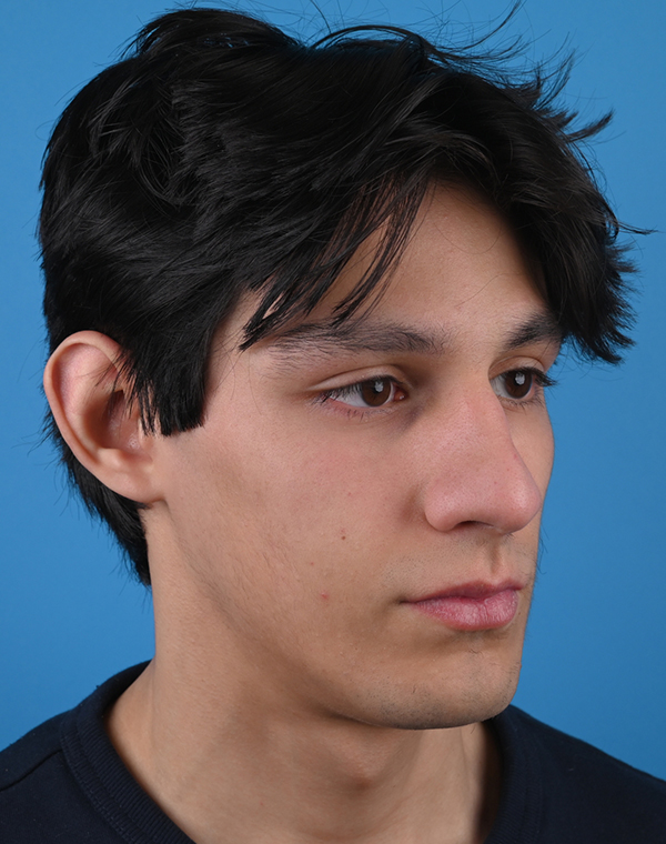 Otoplasty