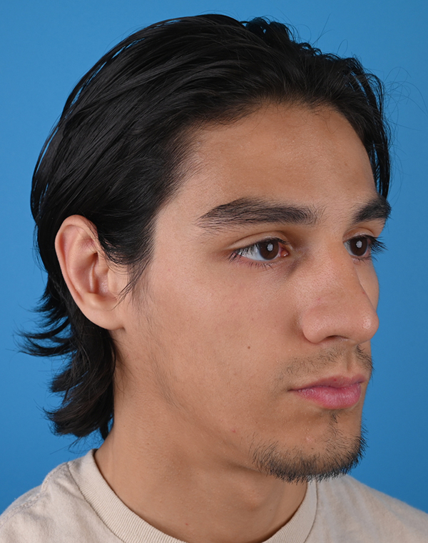 Otoplasty