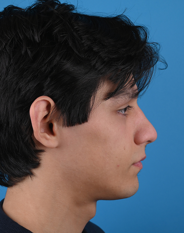 Otoplasty