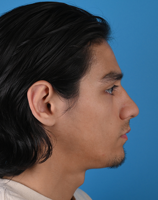 Otoplasty