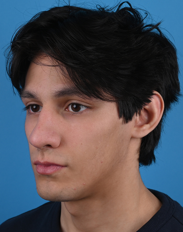 Otoplasty