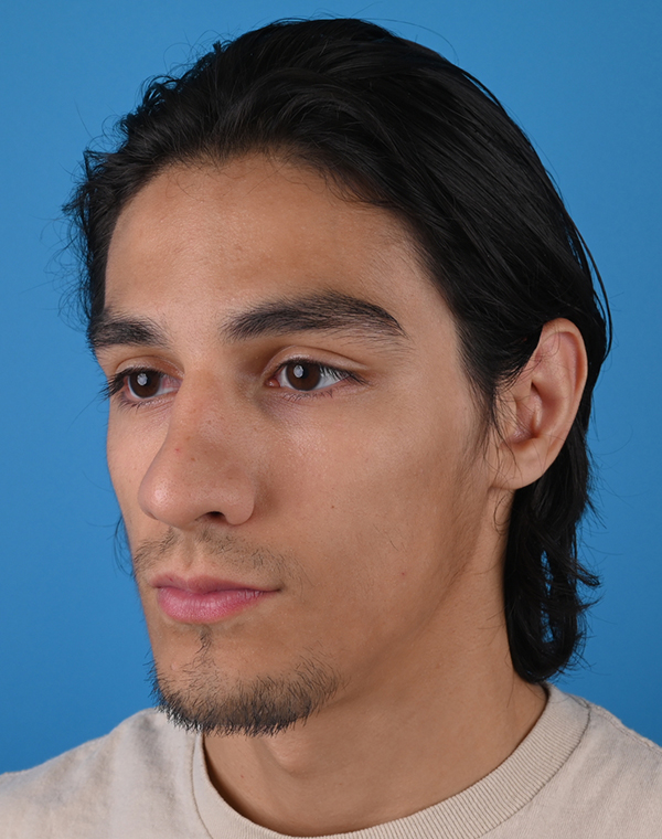 Otoplasty