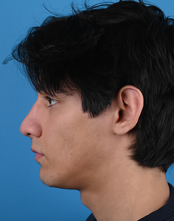 Otoplasty