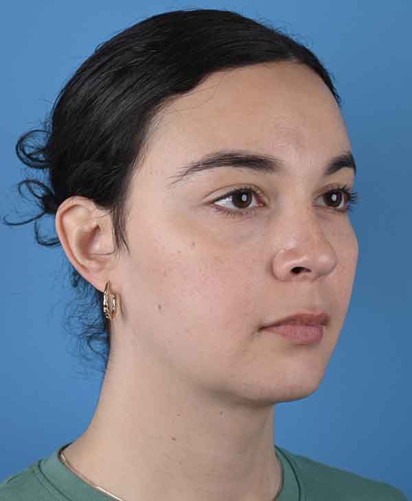 Facial Feminization