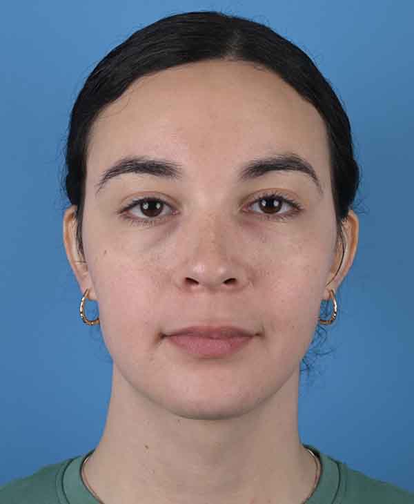 Facial Feminization