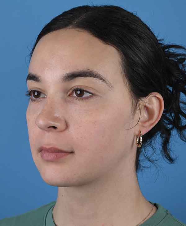Facial Feminization