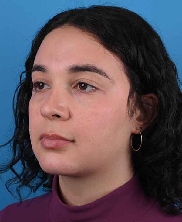 Facial Feminization