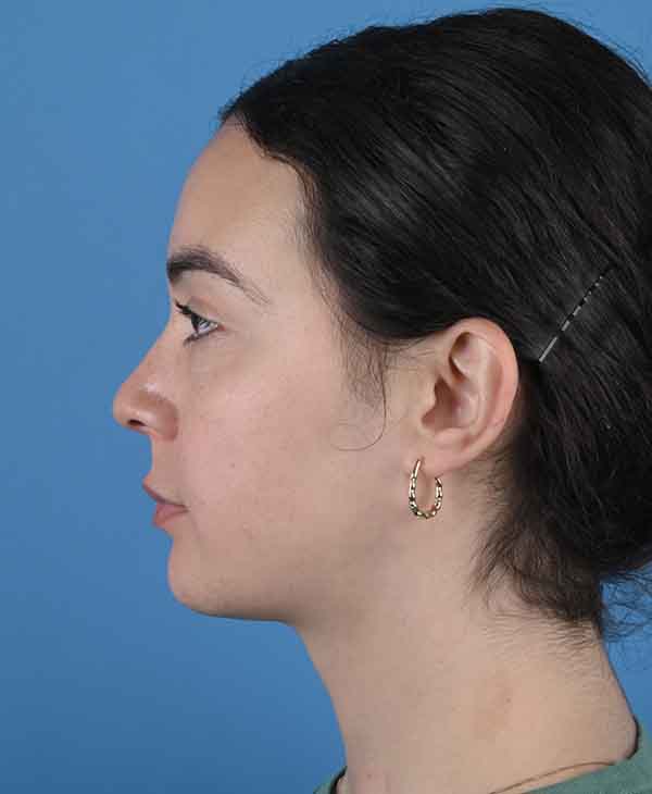Facial Feminization