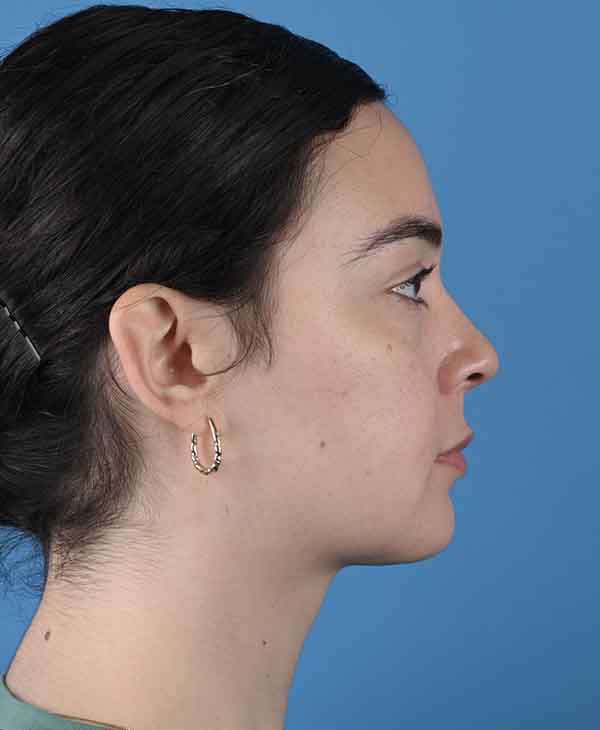 Facial Feminization