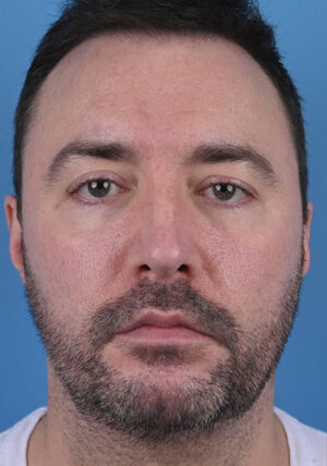 Pre-surgery neck liposuction photo