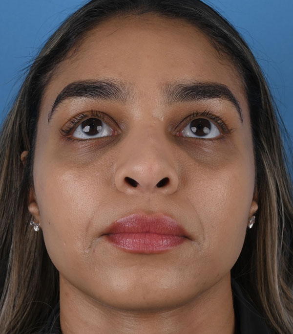 Rhinoplasty