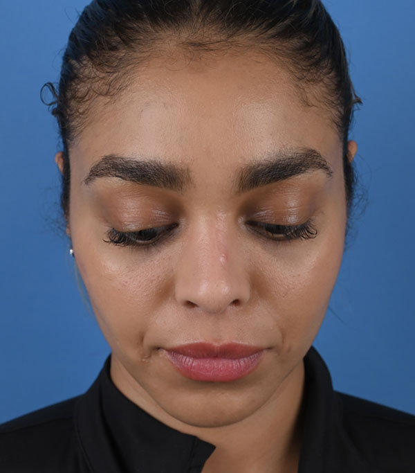 Rhinoplasty