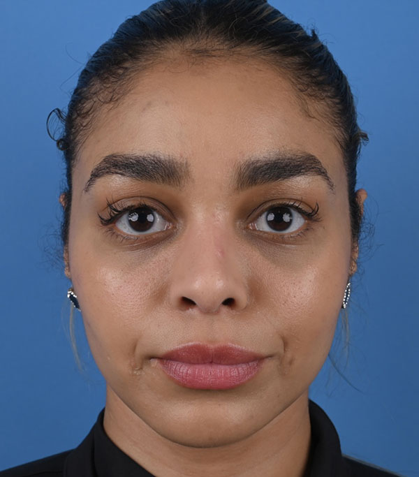 Rhinoplasty