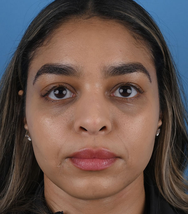 Rhinoplasty