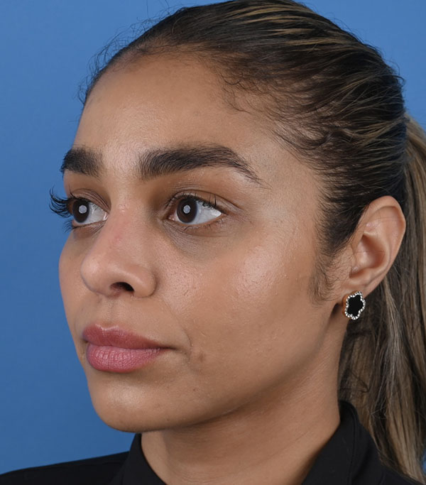 Rhinoplasty
